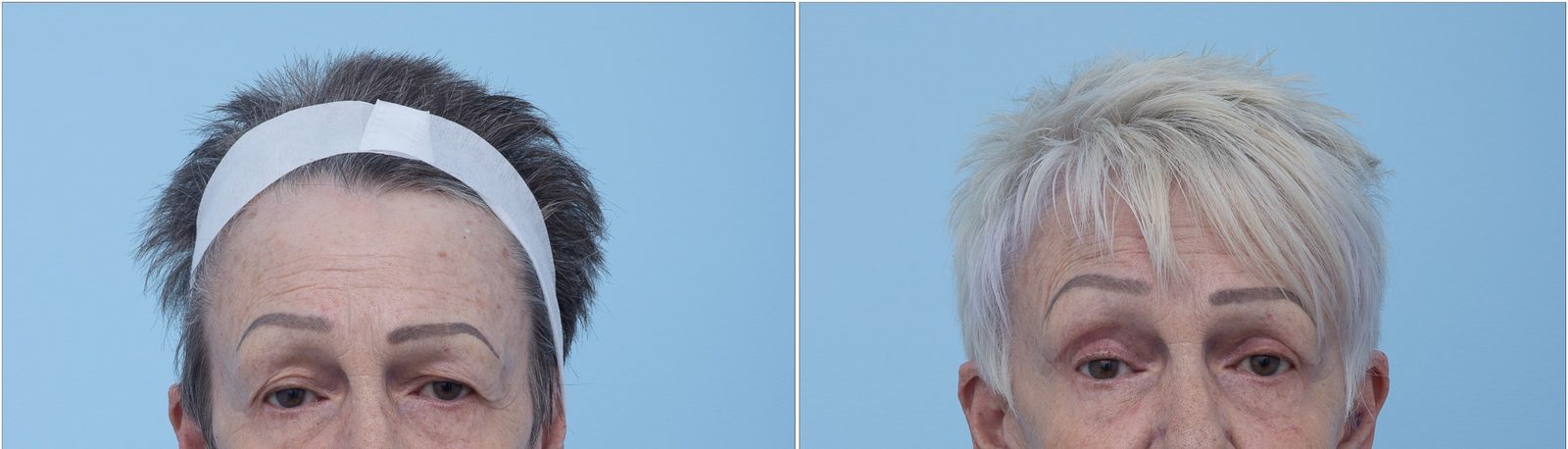 Combined brow lift and upper blepharoplasty result, front view — non-identifying
