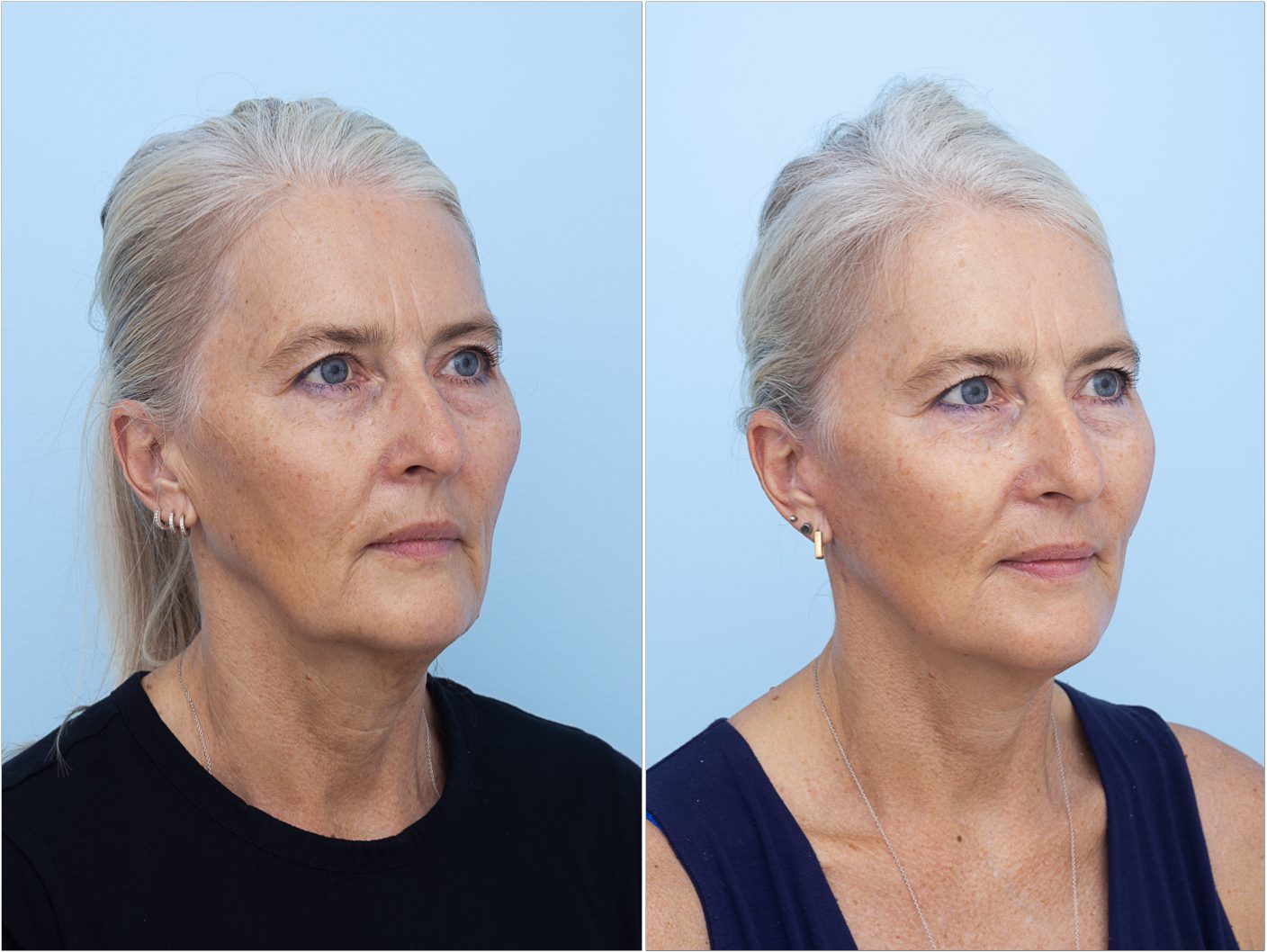 Mini facelift result, oblique view — non-identifying